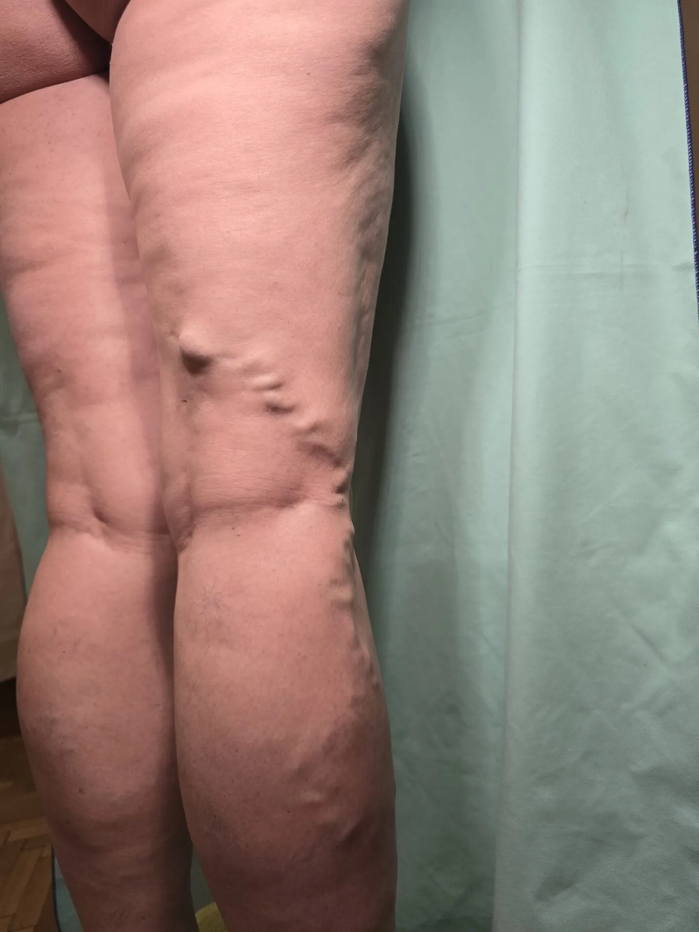 BKE eset – visszér műtét előtti állapot