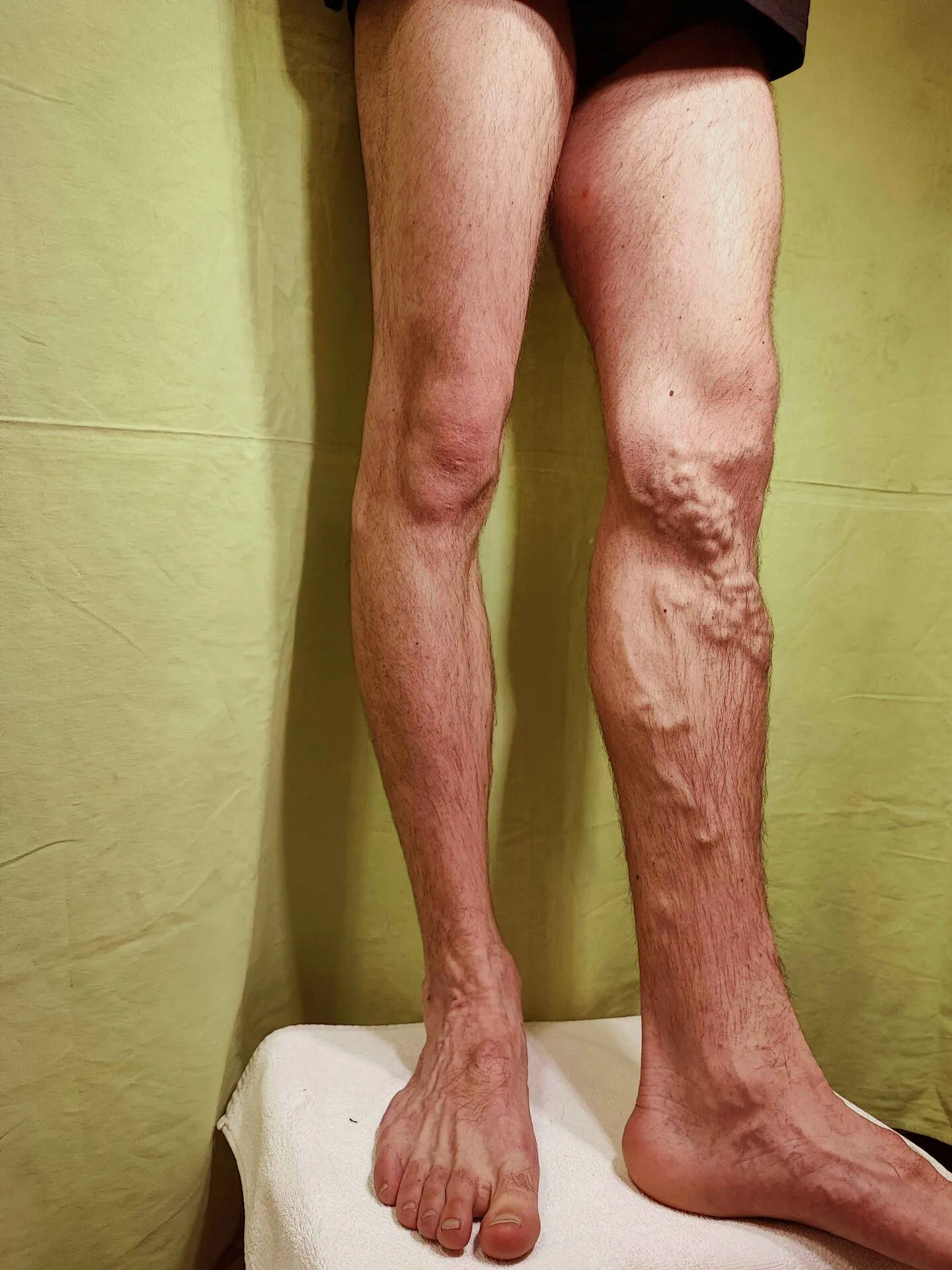 Gz eset – visszér kezelés előtti fotó