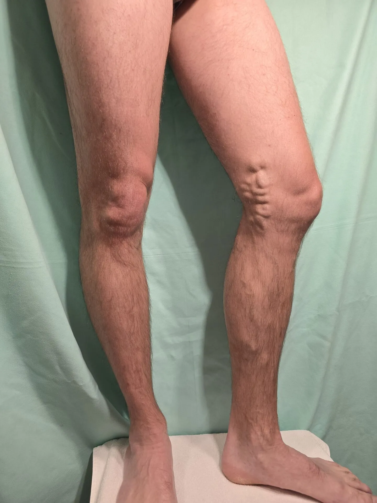 KB eset – szkleroterápia előtti állapot